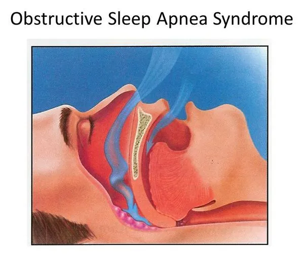 Cиндром обструктивного апноэ во сне